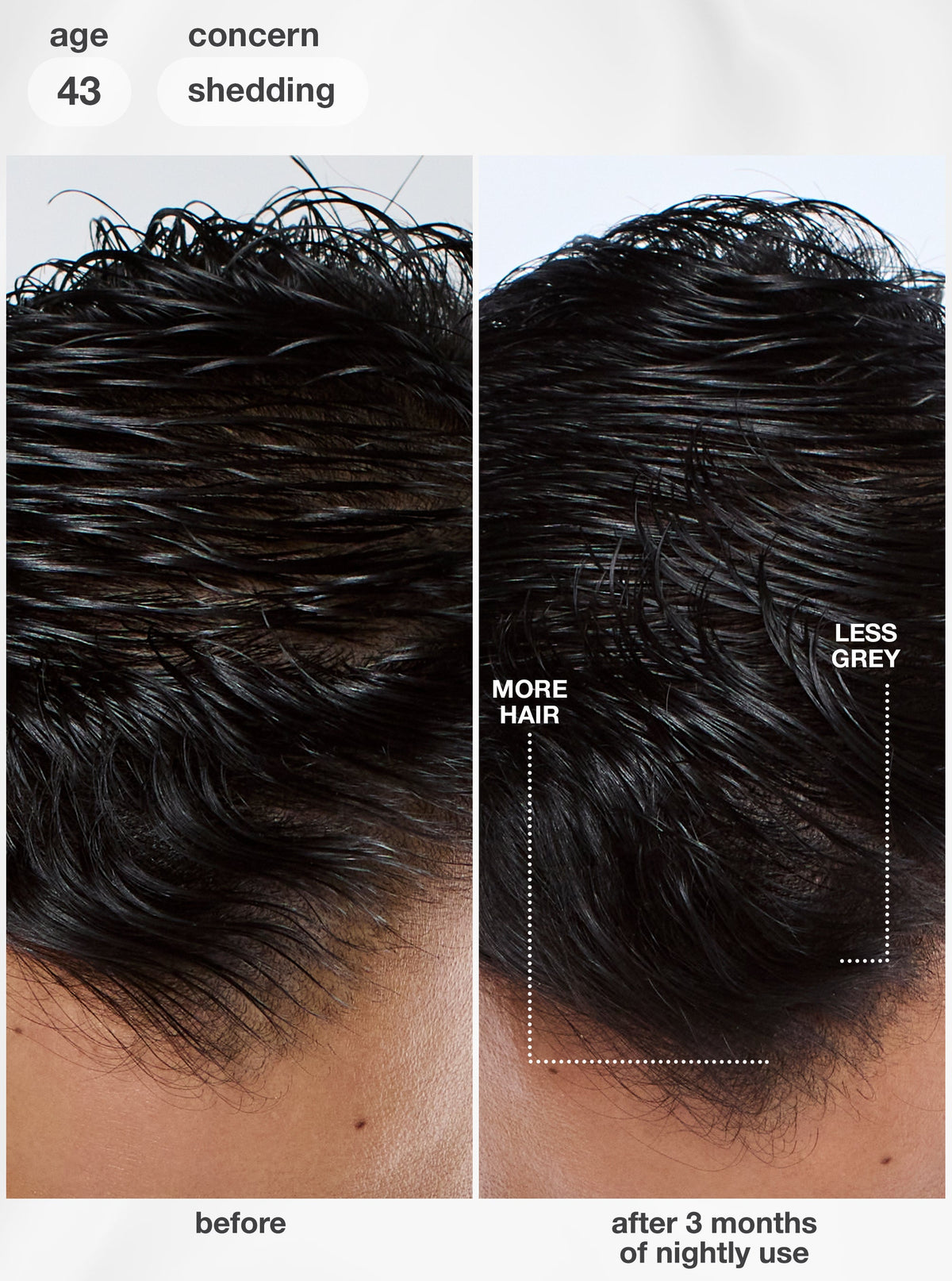 Manufacturer before-and-after hairline photos following three months of nightly K18 FutureIQ use.