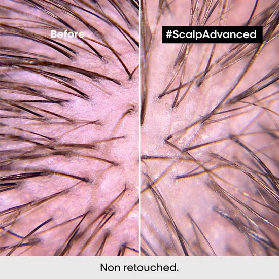 L'Oréal Professionnel Scalp Advanced Anti-Discomfort Duo Bundle